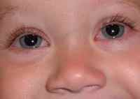 Аллергический конъюнктивит у ребенка что делать
