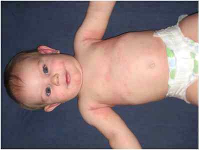 Аллергия на глютен у ребенка фото