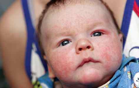 Аллергия на кефир у ребенка 1 год