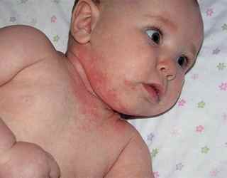 Аллергия на масло у ребенка