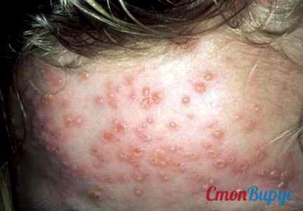 Аллергия на пятках у ребенка