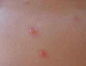 Аллергия на пятках у ребенка
