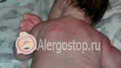 Аллергия на подсолнечное масло у ребенка