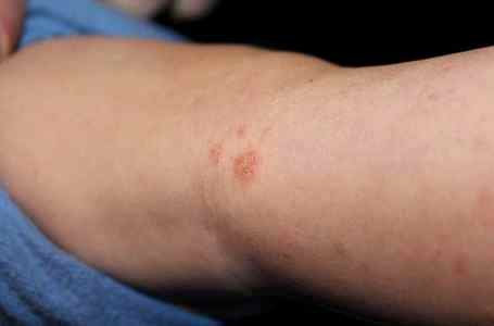 Аллергия на супракс у ребенка как лечить