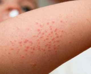 Аллергия на творог у ребенка симптомы