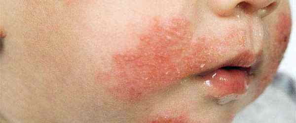 Аллергия у 2 летнего ребенка