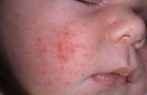 Аллергия у 2 месячного ребенка на лице
