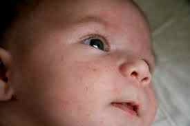 Аллергия у 2 месячного ребенка на лице