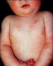 Аллергия у грудного ребенка комаровский видео