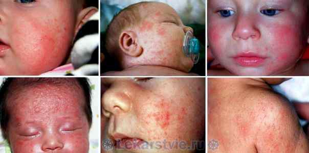 Аллергия у грудного ребенка комаровский видео