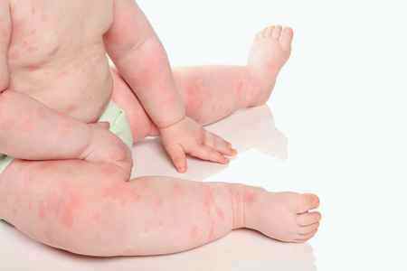 Аллергия у грудных детей фото