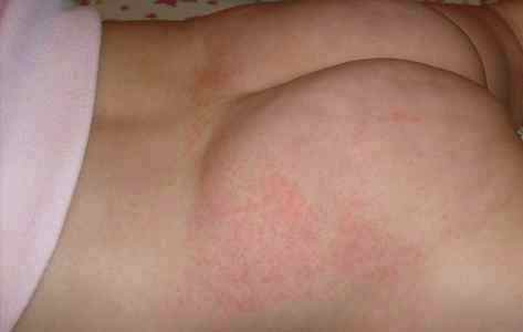 Аллергия у грудных детей фото