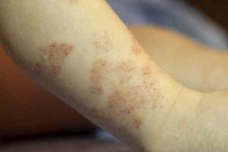 Аллергия у ребенка 1 год форум