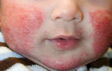 Аллергия у ребенка 1 год лавровый лист