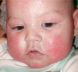 Аллергия у ребенка 1 год лавровый лист