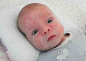 Аллергия у ребенка 3 месяца на искусственном вскармливании