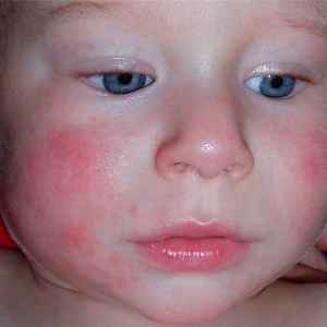 Аллергия у ребенка 4 месяца чем лечить