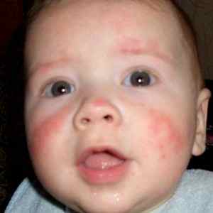 Аллергия у ребенка 4 месяца чем лечить