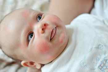 Аллергия у ребенка 4 месяца на грудном вскармливании лечение