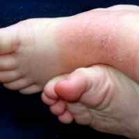 Аллергия у ребенка 9 месяцев