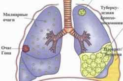 Инфекционно аллергическая бронхиальная астма у детей