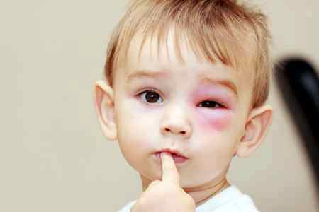Отек при аллергии у ребенка
