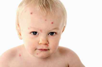 Пищевая аллергия у детей как лечить