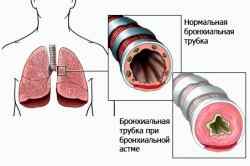 Проявление астмы у детей до года
