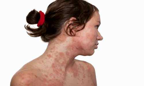 Сильная аллергия у ребенка на лице