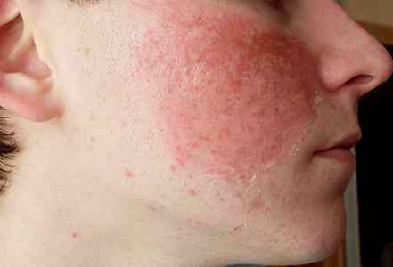 Сильная аллергия у ребенка на лице