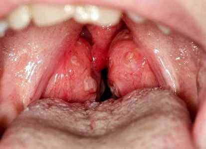 Гипертрофия небных миндалин у детей 3 степени лечение