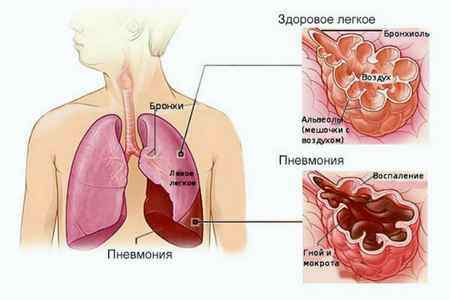Пневмония у ребенка 1 5 года