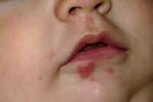 Симптомы герпеса у грудного ребенка