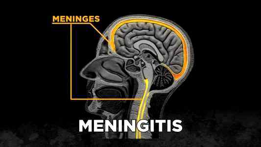 Симптомы менингита у грудного ребенка
