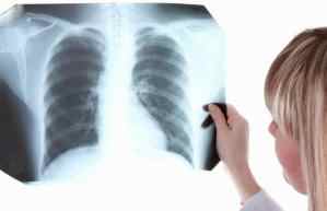 Туберкулезная интоксикация у детей и подростков клиника диагностика