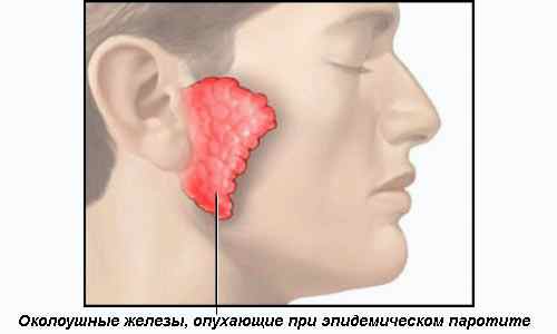 Если мальчик болел свинкой будут ли у него дети