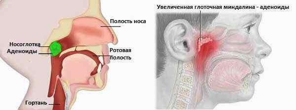 Звонкий кашель у ребенка чем лечить