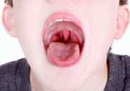 Аденоиды в носу у детей симптомы фото