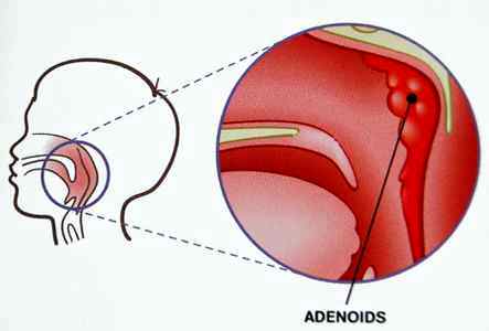 Современные методы лечения аденоидов у детей
