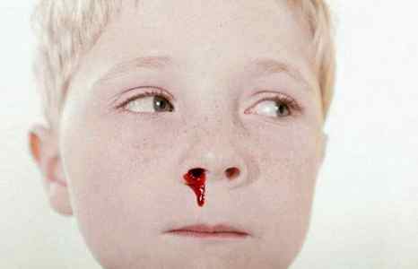 Частые носовые кровотечения у ребенка 6 лет