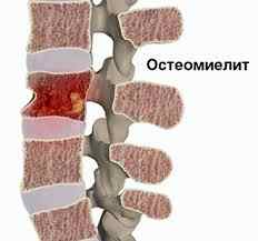 Гематогенный остеомиелит у детей диагностика