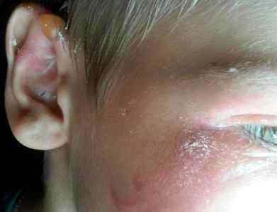 Ожог от борщевика у ребенка лечение