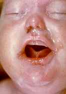 Признаки врожденного сифилиса у ребенка