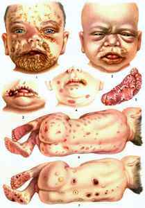 Признаки врожденного сифилиса у ребенка