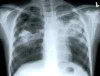 Симптомы туберкулеза у детей 15 лет
