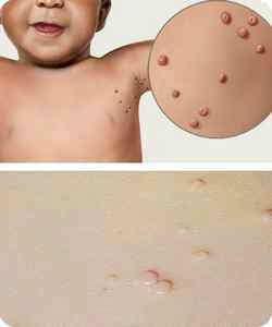 Заболевание моллюск у детей лечение