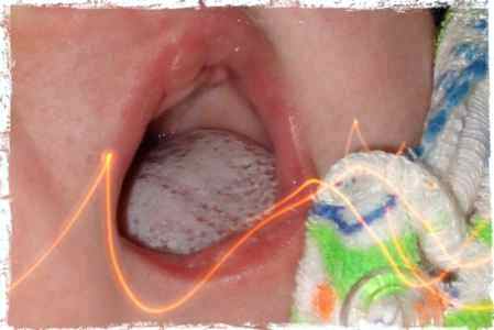 Язвочки на языке у ребенка причины и лечение фото