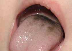 У ребенка почернел язык после антибиотиков