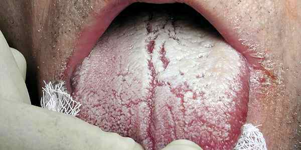 Как лечить кандидоз полости рта у детей