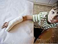 Перелом лучевой кости у детей лечение